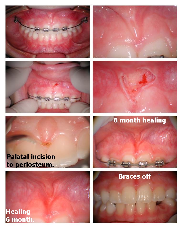 Frenectomy 2.jpg